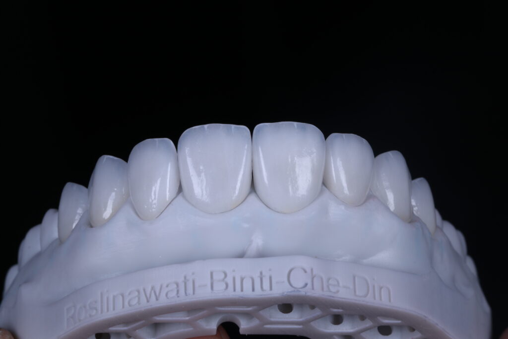 Wonderful. And natural. IPS e.max Ceram is the fluorapatite glass-ceramic for the highly esthetic veneering and characterization of IPS e.max lithium disilicate glass-ceramics (LS2) and zirconium oxide (ZrO2).The material structure of the IPS e.max Ceram veneering materials is modelled on nature, mimicking the natural tooth structure in translucency, opacity and fluorescence.IPS e.max Ceram features compatibility with all veneering techniques, offering maximum flexibility and ample scope for creativity.
