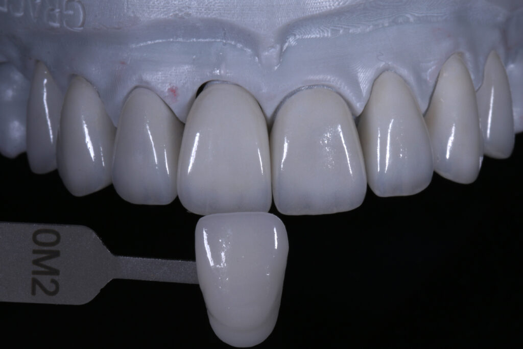Ivoclar cosmetic emax veneer china dental lab best cosmetic emax crowns veneers
