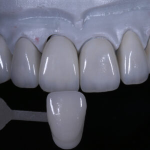 Ivoclar cosmetic emax veneer china dental lab best cosmetic emax crowns veneers