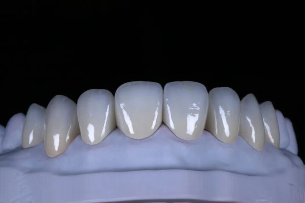 Quality and esthetics – The esthetic appearance of the material is comparable to that of IPS e.max lithium disilicate – High strength, stability and durability and a wide variety of applications – Easy placement with conventional cements or self-adhesive luting materials Our Zirconia has versatile uses and is characterized by outstanding quality and superb esthetics.